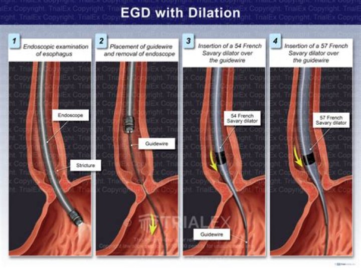 EGD With Bravo pH Placement