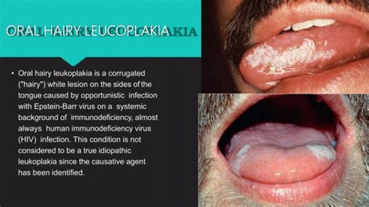 Twenty-first-century oral hairy leukoplakia-a non-HIV-associated entity - ePrints