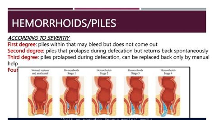 When Should You Seek Care for Hemorrhoids?